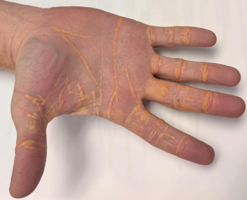 Cholesterol Hands (Courtiness Jama Network / American Medical Association)