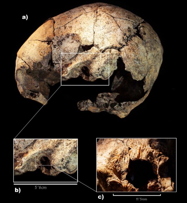 Set of cut marks identified on the left temporal bone of the skull.  Inserts: Enlarged images of the cut marks in the left ear, next to the mastoid.