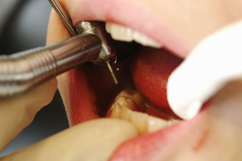 Extreme close up photo of dental work being performed on a child's mouth.