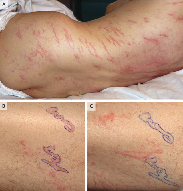 A wavy rash that moves across the man's body.  Panels B and C show the larval movement over 24 hours.