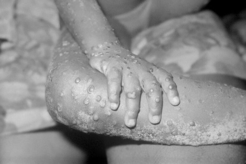 A 2003 photo of the arms and legs of a 4-year-old girl infected with monkey pox in Liberia. 