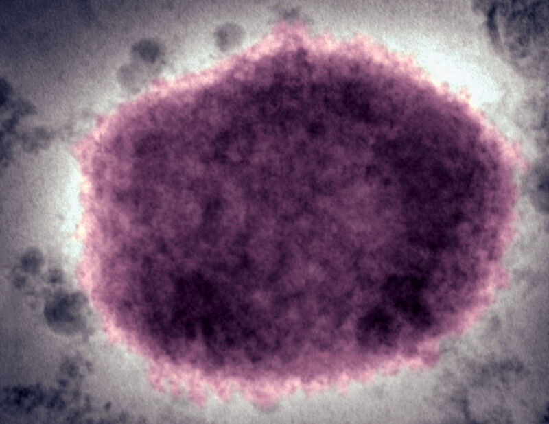 A negative color electron micrograph of a monkeypox virus virion in human vesicle fluid. 